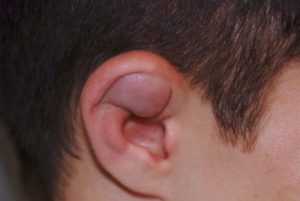 Сломаны хрящи уха