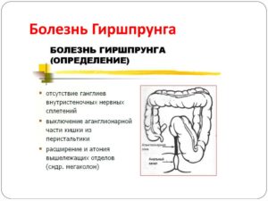 Болезнь Гиршпрунга (аганглионарный мегаколон)