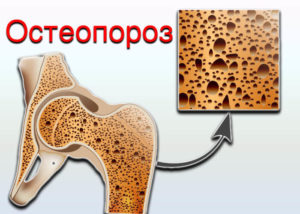 Что такое остеопороз? Что вам необходимо знать