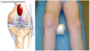 синовит и бурсит коленного сустава