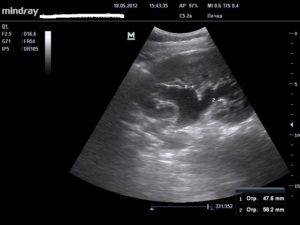 Гидрокаликоз правой почки у беременной 25 неделя беременности