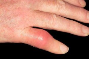 Симптомы болезни - боли в пальце
