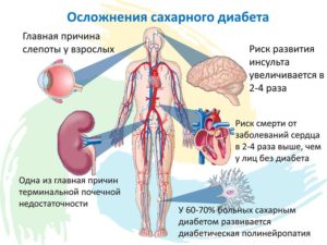 Сахарный диабет 2 типа: Лечение осложнений