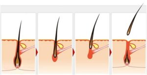 Как уничтожить волосяную луковицу