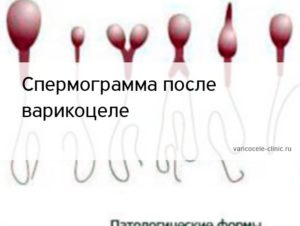 спермограмма после операции варикоцеле