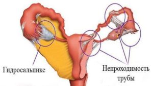 гидросальпинкс и беременность