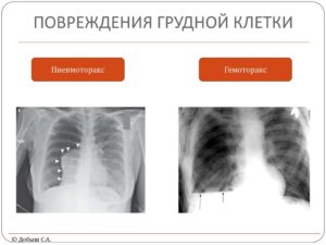 Повреждения грудной клетки