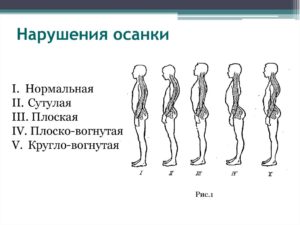 Нарушение осанки