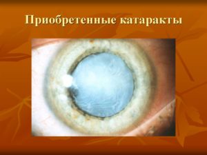 Приобретенные катаракты