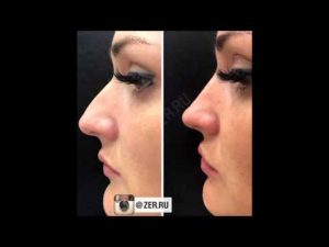 Косметические процедуры: изменение формы носа