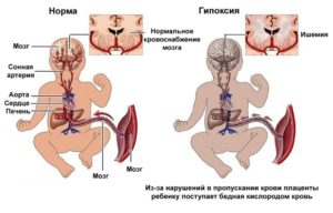 Симптомы болезни - нарушения плодово плацентарного кровотока