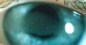 Ювенильный артрит и глаза