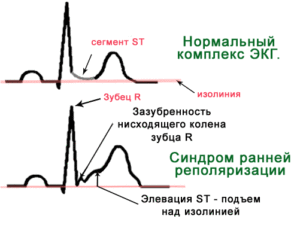 Симптомы болезни - нарушенияпроцессов реполяризации желудочков