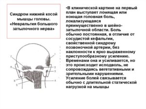 Осложнения остеохондроза – головная боль и синдром нижней косой мышцы головы