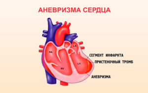 Постинфарктная аневризма сердца