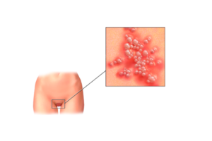 Лечение генитального герпеса в домашних условиях