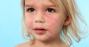Аллергия на флемоксин солютаб