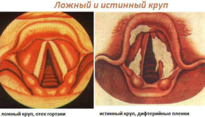 Подскладочный ларингит (ложный круп)