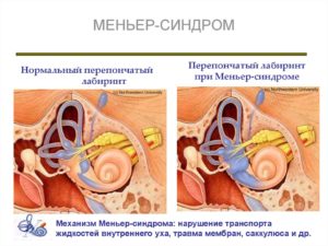 Болезнь Меньера (продолжение...)