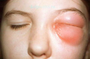 Воспалительные заболевания глазницы