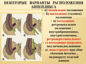 Типичные формы острого аппендицита