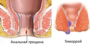 Анальная трещина при беременности