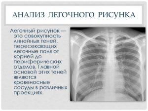 ФЛГ: Обогащён прикорневой лёгочный рисунок