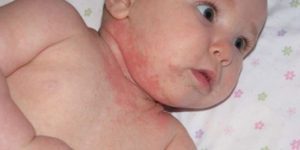 Аллергия у ребенка 9 месяцев