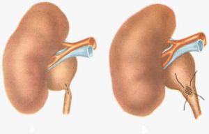 каликопиелоуретероэктазия правой почки