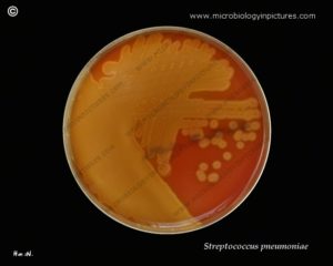 обильный рост Streptococcus pneumoniae, Neisseria flavescens в зеве