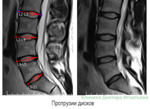 Страдаю от межпозвоночной грыжи - Л4-Л5 - 5мм + Л5-С1 - 5мм