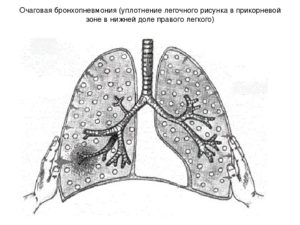 ФЛГ: Обогащён прикорневой лёгочный рисунок