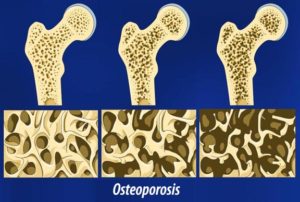 Пятнистый посттравматический остеопороз и другие осложнения