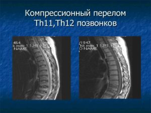 Компрессионный перелом Th 11