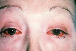 Симптомы болезней у женщин – Глаза