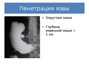 Пенетрация язвы желудка и двенадцатиперстной кишки