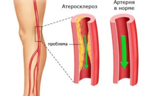 Облитерирующий атеросклероз