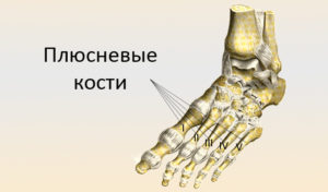 Головки плюсневых костей