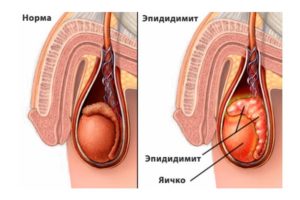 Мокреет головка и дискомфорт в правом яичке
