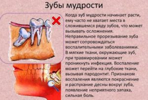 Болит зуб мудрости: что делать?