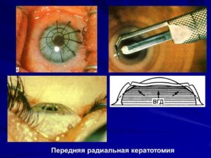 Хирургические способы коррекции аномалий рефракции (продолжение...)