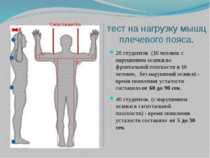 Симптомы болезни - нарушения осанки