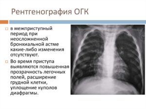 Расшифровка рентгена ОГК