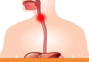 Симптомы болезни - боли в пищеводе