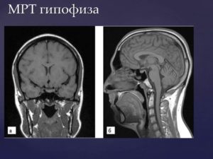 МРТ гипофиза при повышенном пролактине