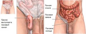 Симптомы болезни - боли в области паха