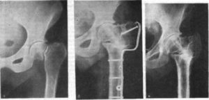 подвертельный патологический перелом шейки бедра