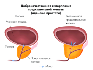 Лечение ГППЖ аденормом