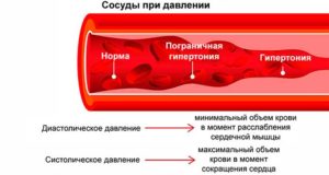 Гипертония: Высокое артериальное давление и атеросклероз