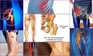 Симптомы болезни - боли в ягодице